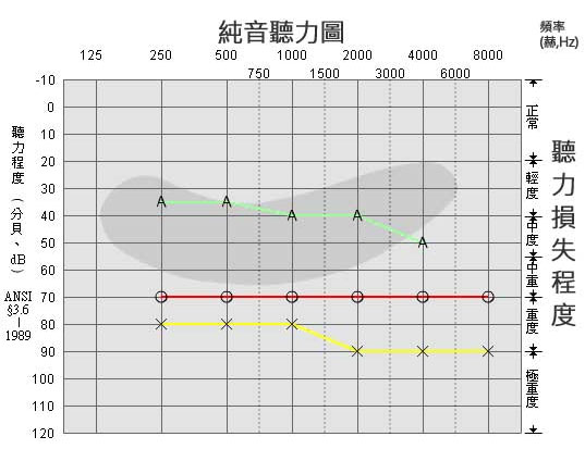純音測(cè)試圖怎么看[純音測(cè)試結(jié)果怎么看]