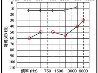 助聽器能恢復聽力嗎